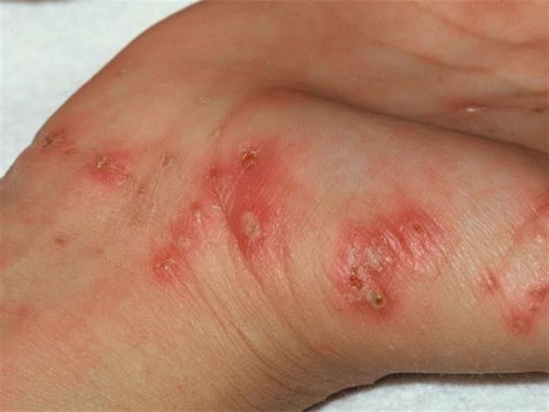 Повреждения на коже при чесотке