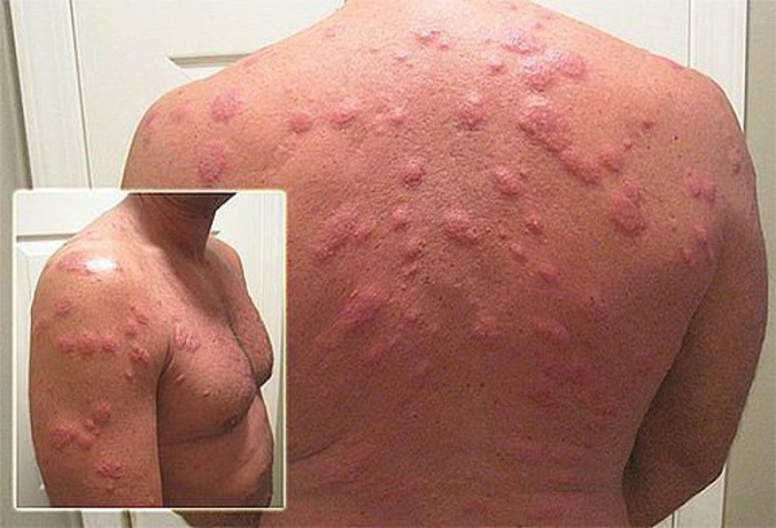 Аллергия на клеща пылевого 