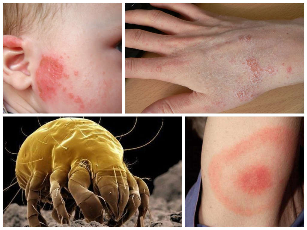 Аллергия на клопиные укусы
